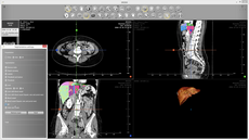 Segmentation of the liver