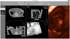 virtual colonoscopy