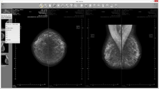 mammography