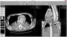 meansurements in dicom viewer