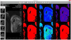 perfusion maps