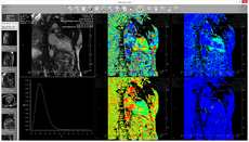 Perfusion, removing movement artifacts